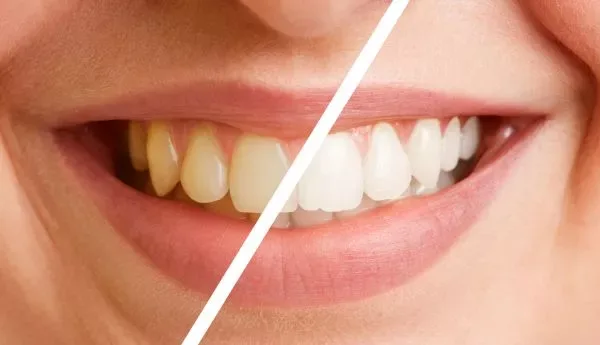 A smile split by a diagonal line, with yellowed natural teeth on one side and a brighter whitened shade on the other